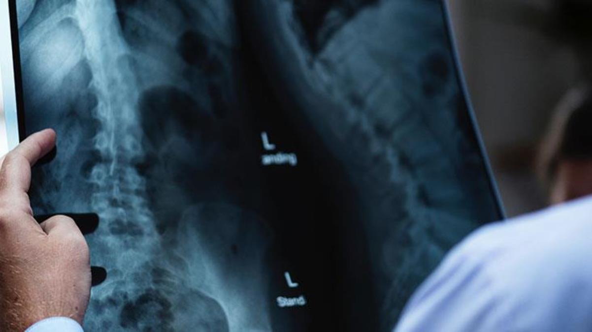 1 yıldır yemek yiyemeyen adamın midesinin röntgeni çekildi, çıktıyı alan doktor hemen ekibini topladı